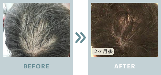 ビフォーアフター 薄毛